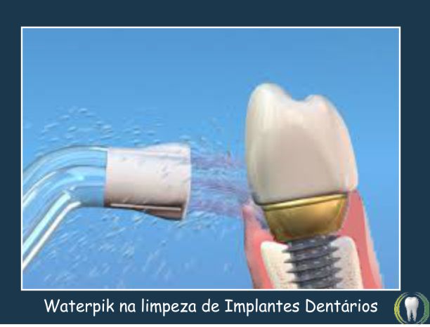 waterpik implante dentario