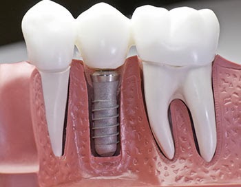 Leia mais sobre o artigo Implantes Dentários: 5 motivos (que você deveria saber) para instalar o mais rápido possível