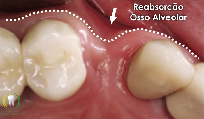 reabsorcao osso alveolar