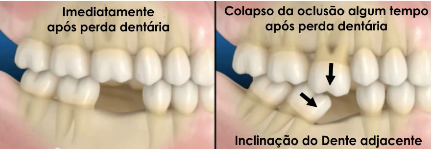 colapso oclusal perda dentaria