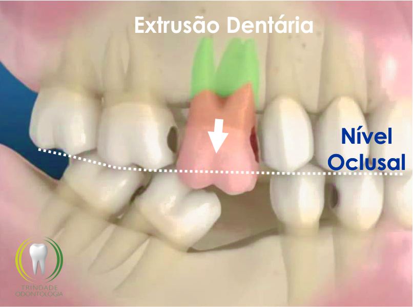 extrusao dentaria