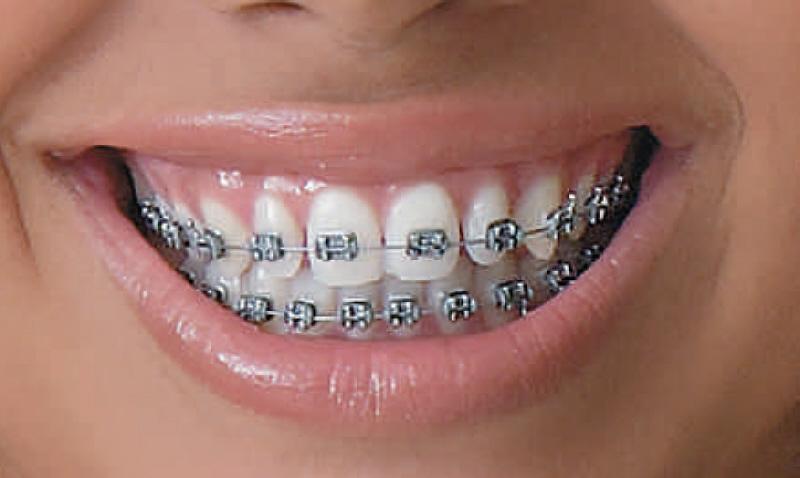 aparelho ortodontico fixo convencional