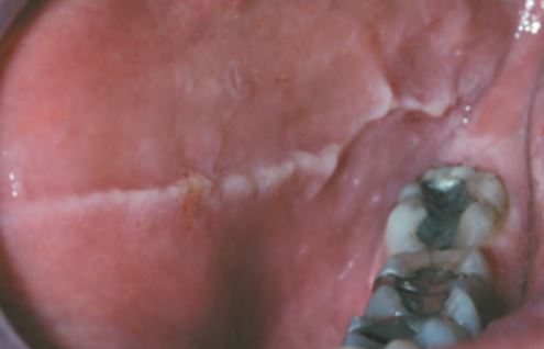 Lesão branca por mordida crônica da bochecha