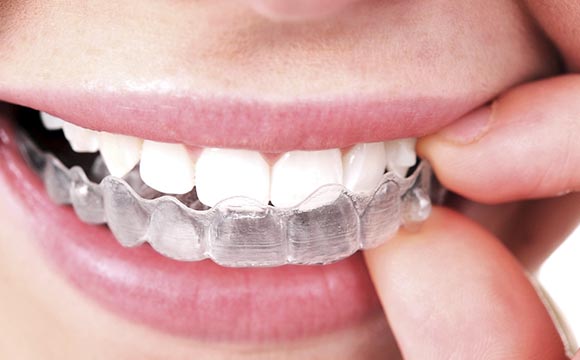 Ortodontia com Alinhadores Invisíveis - Ortex Odontologia