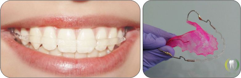 contencao ortodontica estetica