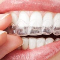 Clareamento Dental Caseiro ou a Laser: qual o melhor?