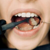O que fazer para o Clareamento Dental durar mais?