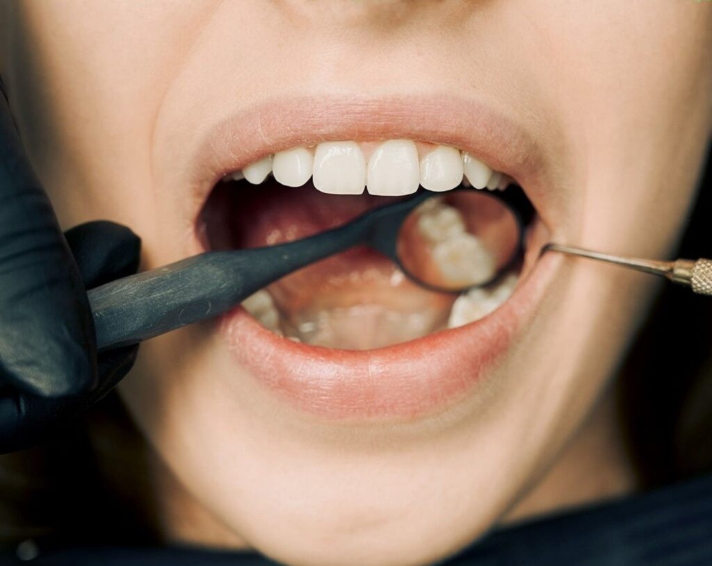 Leia mais sobre o artigo O que fazer para o Clareamento Dental durar mais?