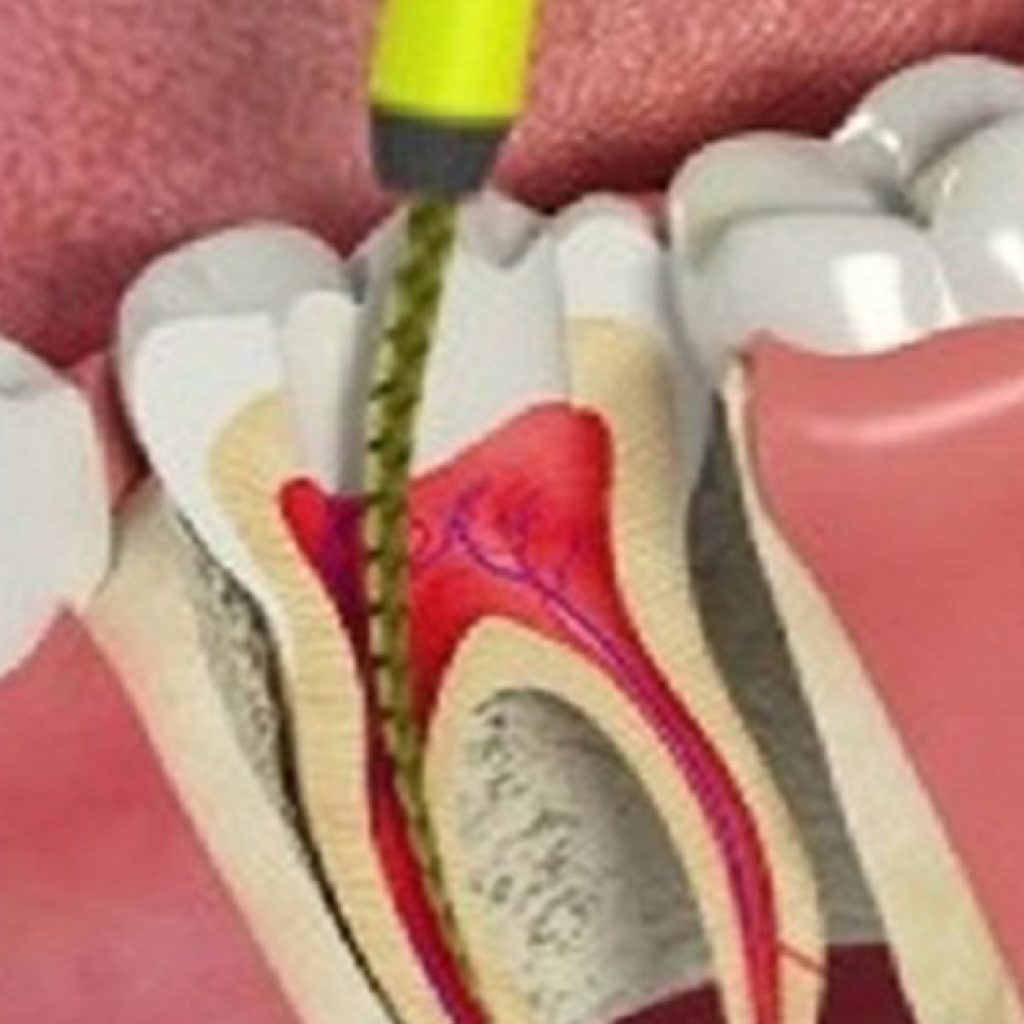 Зубной канал это в стоматологии