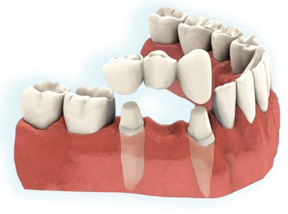 protese fixa 3 dentes