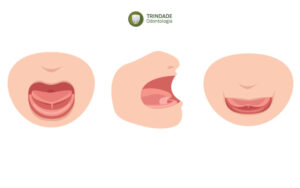 Fênulo da língua - Trindade Odontologia
